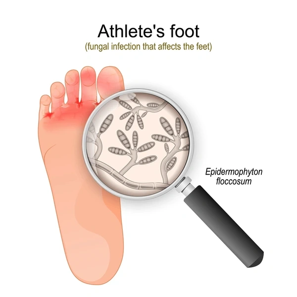 athletes foot treatment in east mesa, az