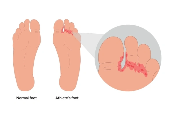 athletes foot treatment near you