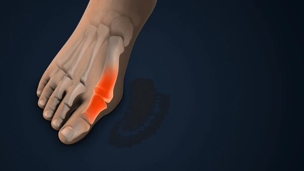 bunions treatment in east mesa, az