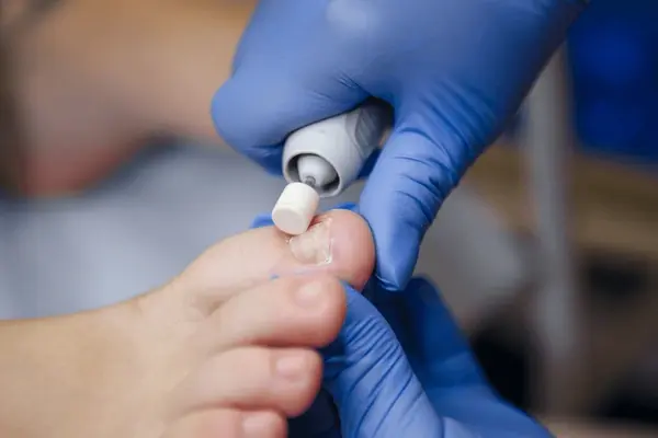 ingrown toenails treatment in east mesa, az