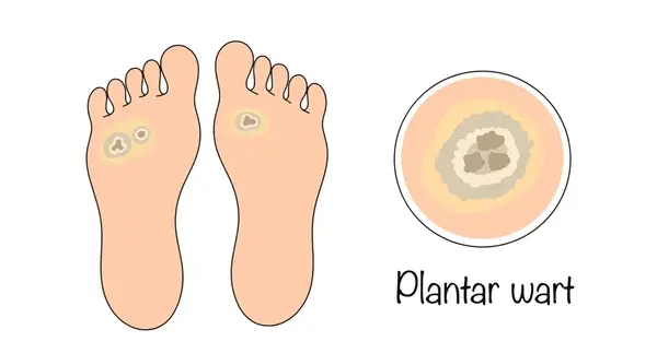 wart treatment in east mesa, az
