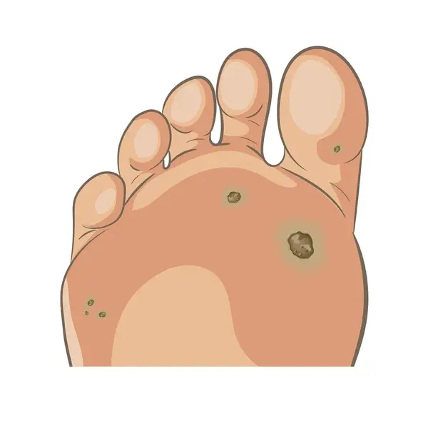 wart treatment near you